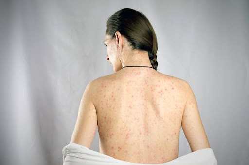 Dị ứng côn trùng cắn tại sao bạn luôn ngứa ngáy khó chịu?