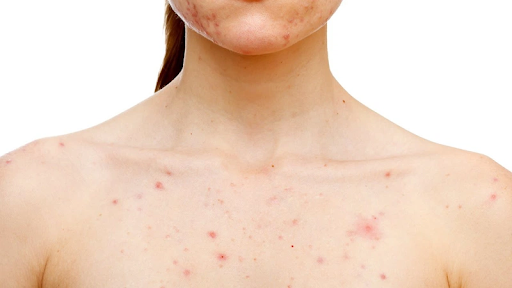 Dị ứng côn trùng cắn tại sao bạn luôn ngứa ngáy khó chịu?