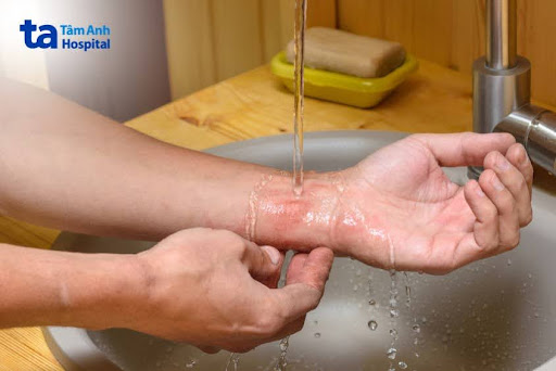 Kiến ba khoang và viêm da tiếp xúc nguy hiểm cần cảnh giác